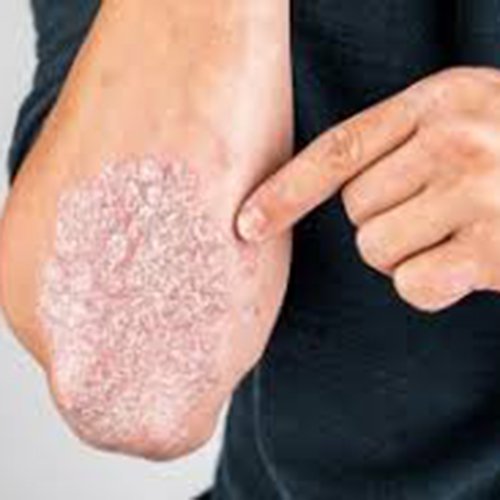 চর্মরোগের ক্রিম