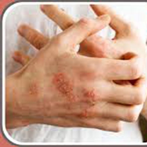 চর্মরোগের ক্রিম